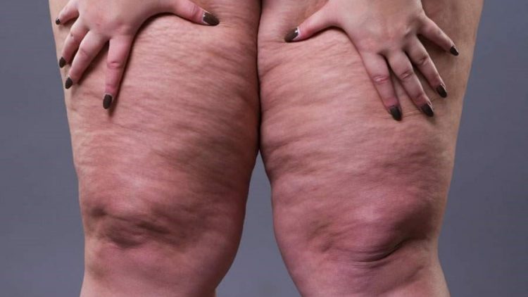 Lipedema: conheça doença confundida com obesidade que afeta mais de 11% das mulheres